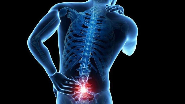 Lumbar osteochondrosic symptoms